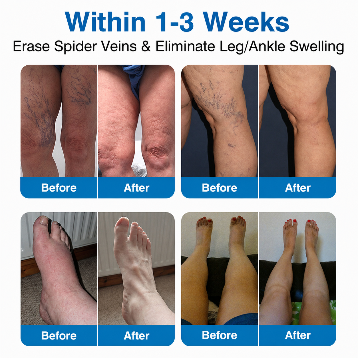 🇨🇦🏆✅️🏃Unitedne® VeinRepair Microneedle Patch Roll⚡Instant Relief, Long-Term Results