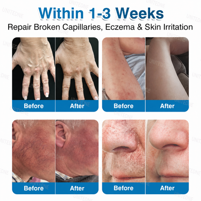 🇨🇦🏆✅️🏃Unitedne® VeinRepair Microneedle Patch Roll⚡Instant Relief, Long-Term Results