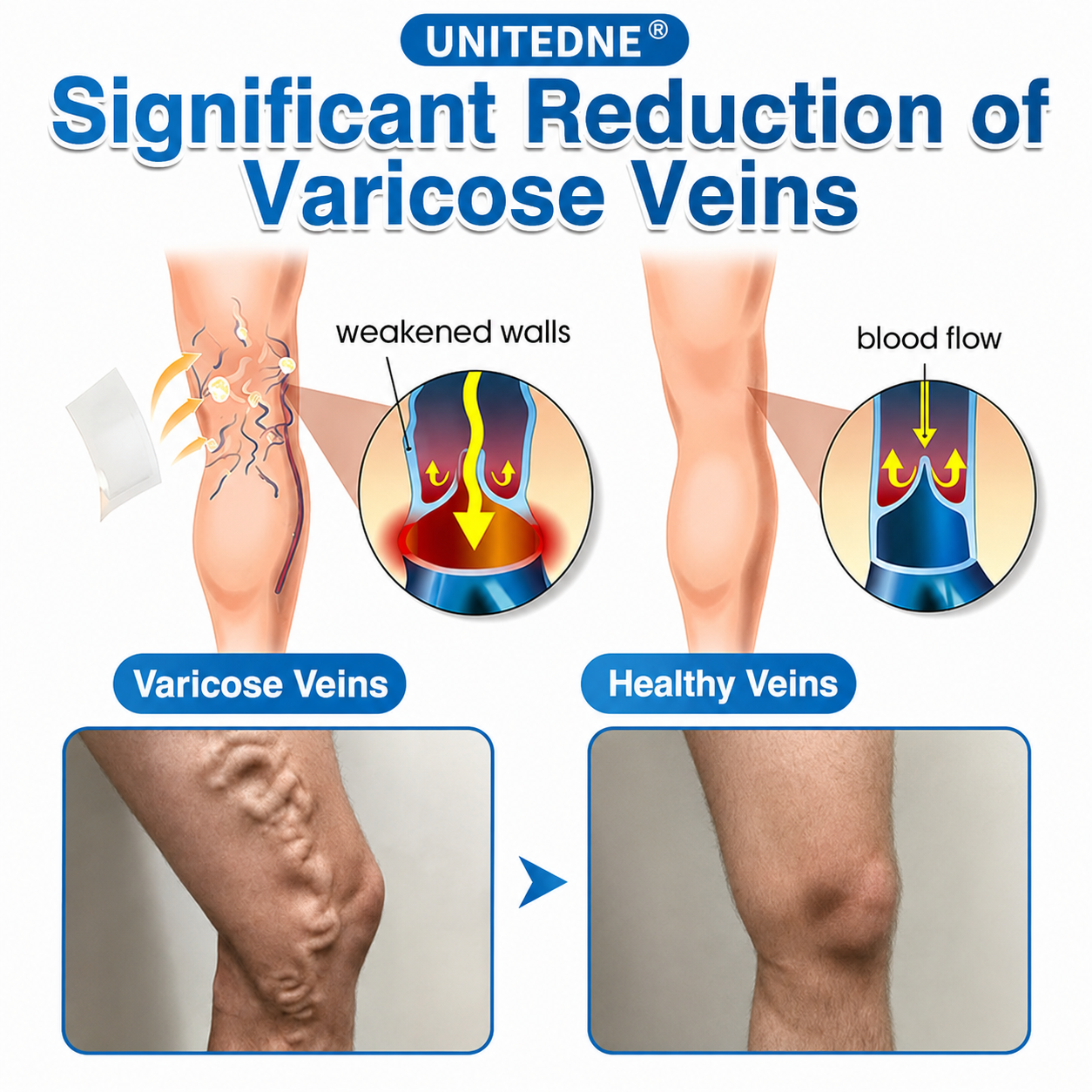 🇨🇦🏆✅️🏃Unitedne® VeinRepair Microneedle Patch Roll⚡Instant Relief, Long-Term Results